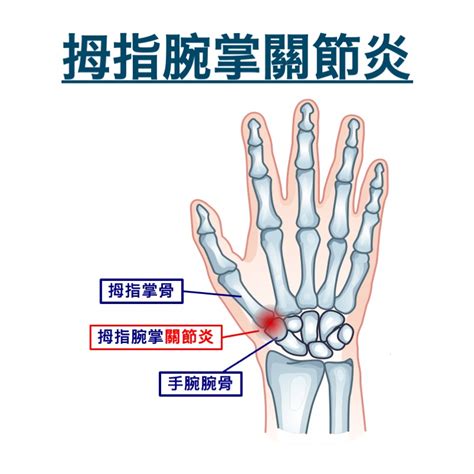 骨節手|手部骨關節炎 